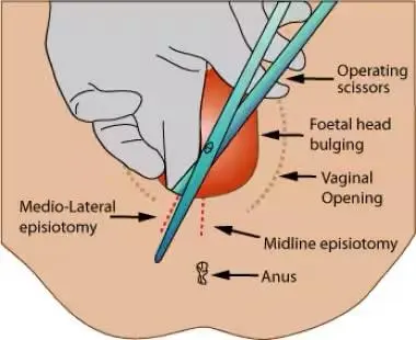 episiotomy mcq discussion 