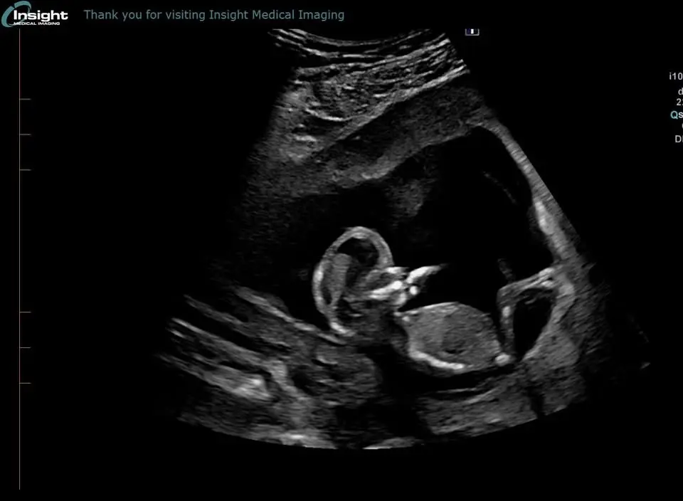 🩵🩷 Gender Reveal 🩷🩵